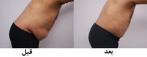 قبل و بعد عمل لیپوساکشن (ناحیه شکم و پهلو)