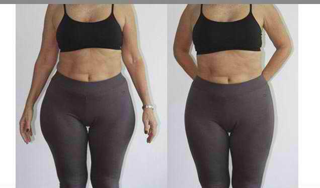 مقایسه لیپوماتیک قبل و بعد (ناحیه ران و کمر )