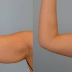 همه چیز درباره لاغری و مقایسه دو دست که لاغر شده