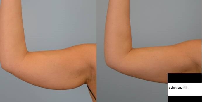 همه چیز درباره لاغری و مقایسه دو دست که لاغر شده